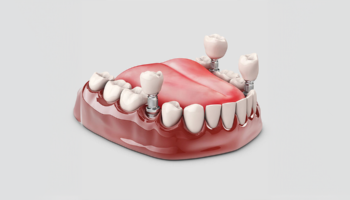 Dental Implants: A Permanent Solution to Tooth Loss