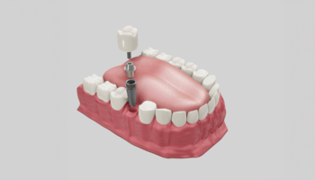 Discover the Magic of Dental Implants